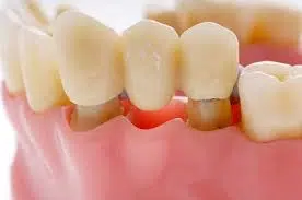 How much Dental bridge cost without insurance